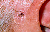 Rodent ulcer next to ear