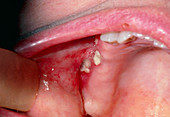 Infection at previously treated gum cancer site