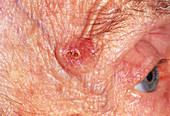 Basal cell carcinoma on temple of elderly woman