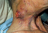 Lymph node tumour on neck of larynx-cancer patient