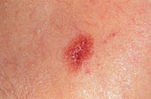 Amelanotic malignant melanoma skin cancer