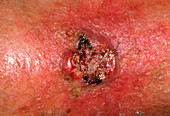 Close-up of a squamous cell carcinoma