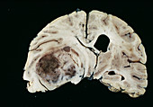 Brain tumour