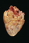 Heart cancer