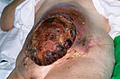 Uterine cancer