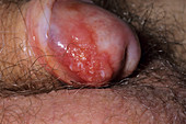 Skin cancer on penis