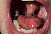 Tongue after cancer removal