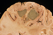 Glioma brain tumour