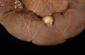 Secondary tumour on the small intestine