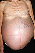 Large abdominal cancer