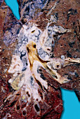 Squamous cell carcinoma lung cancer
