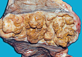Cancer of the small intestine