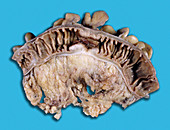 Cancer of the descending colon