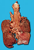 Lung cancer