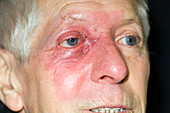 Radiotherapy burn on eye