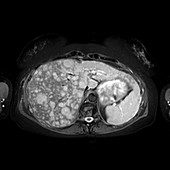 Liver cancer,MRI scan