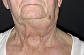 Swollen lymph node due to cancer