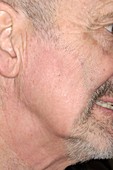 Facial hair loss following radiotherapy