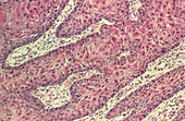 LM of squamous cell cancer of tongue