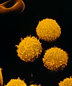 SEM of white blood cells in lymphoid leukaemia