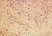 Blood film showing leukaemia