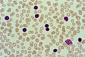 Blood film,acute lymphatic leukaemia