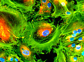 Immunofluorescent LM of kidney cancer cells