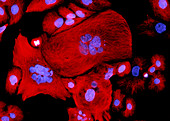 Immunofluorescent LM of bladder cancer cells