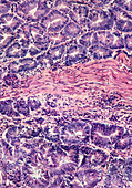 Light micrograph of stomach (gastric) cancer