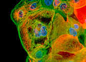 Immunofluorescent LM of squamous carcinoma cells