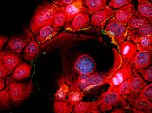 Immunofluorescent LM of squamous carcinoma cells