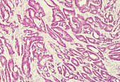 LM of invasive adenocarcinoma of the colon