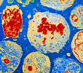Coloured TEM of cancer cells
