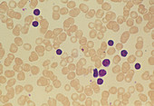 Leukaemia