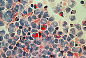LM of lymphocytic leukaemia cells