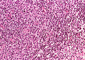 Coloured LM of low grade non-Hodgkin's lymphoma