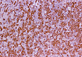 Coloured LM of high grade non-Hodgkin's lymphoma