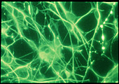 Fluorescence LM of brain tumour culture