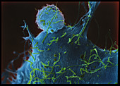 SEM of lymphocytic leukaemia cell