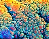 Coloured SEM of cancer cells in the intestine