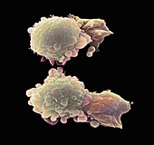 Skin cancer cells,SEM