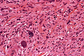 Histiocytoma cancer cells