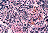 Bone marrow cancer,light micrograph