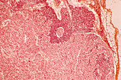 Lymphoma cancer,light micrograph