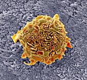 Bone cancer cell,SEM