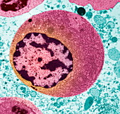 Thyroid cancer cell,TEM