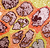 Liver cancer cells,TEM