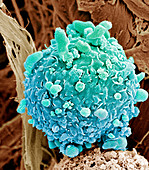 Skin cancer cell,SEM