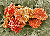 Teratoma cancer cells,SEM