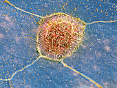 Rectal cancer cells,SEM